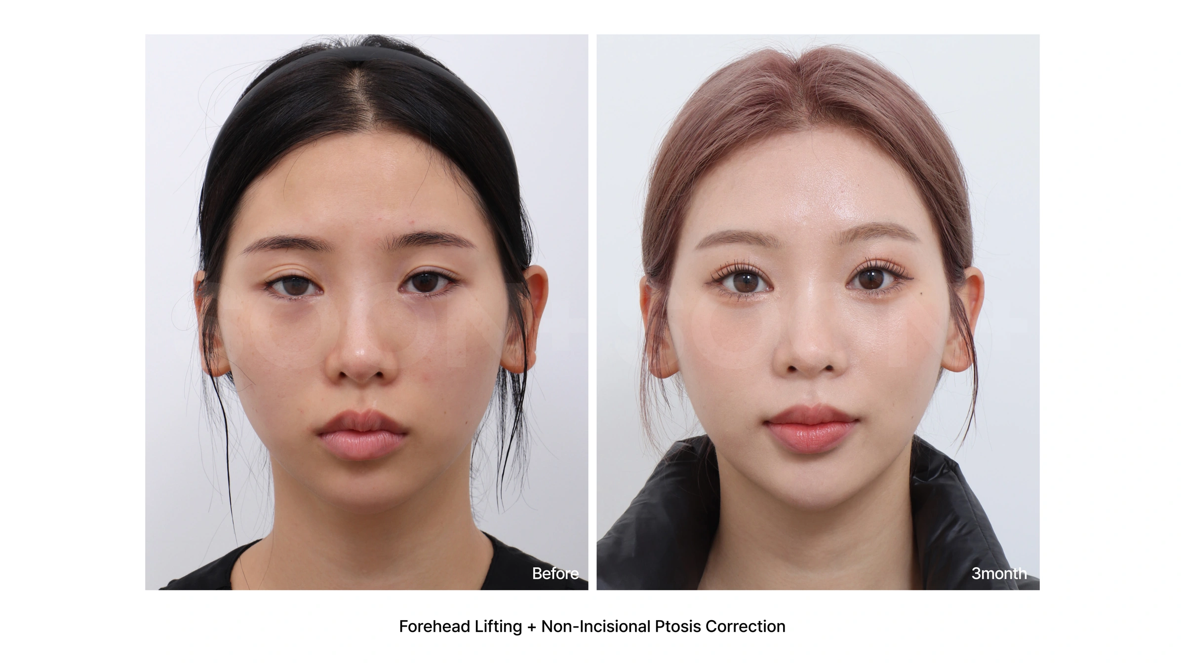 Forehead lift with non-incisional ptosis correction at Soonplus Plastic Surgery. Soonplus Plastic Surgery, Seoul: forehead lift with non-incisional ptosis correction, front facial views, with before on the left and after on the right. The source labels the follow-up as 3 months.