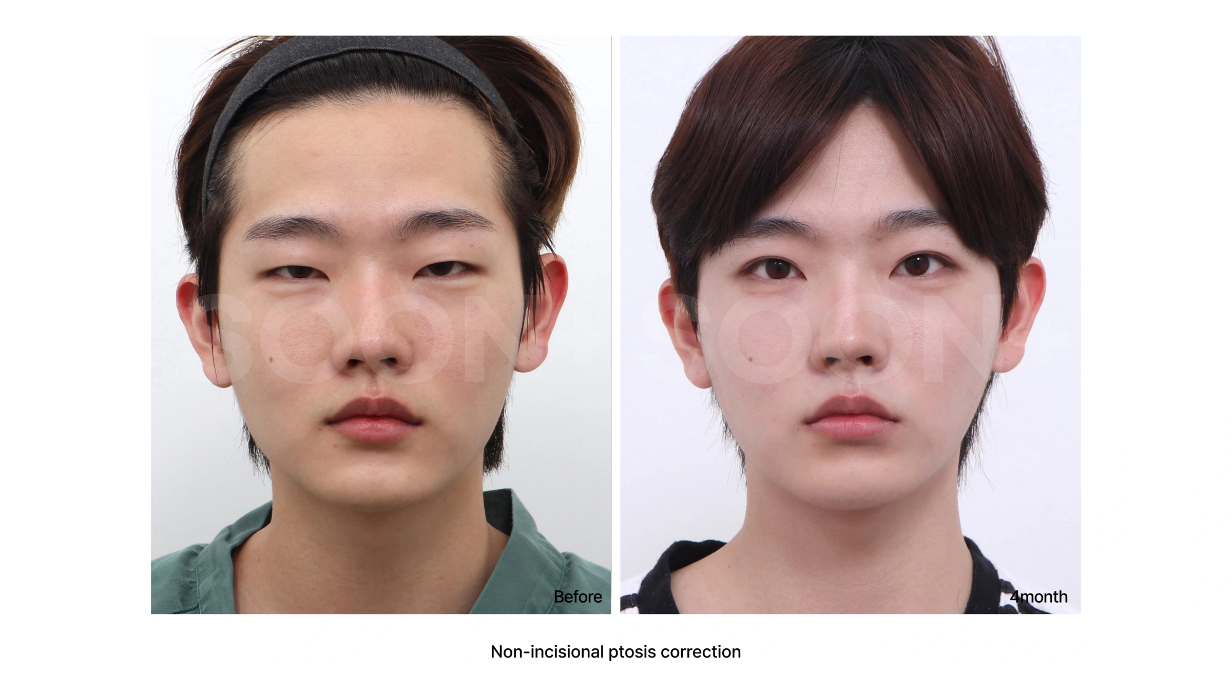 Non-incisional ptosis correction at Soonplus Plastic Surgery. Soonplus Plastic Surgery, Seoul: non-incisional ptosis correction, front facial views, with before on the left and after on the right. The source labels the follow-up as 4 months.