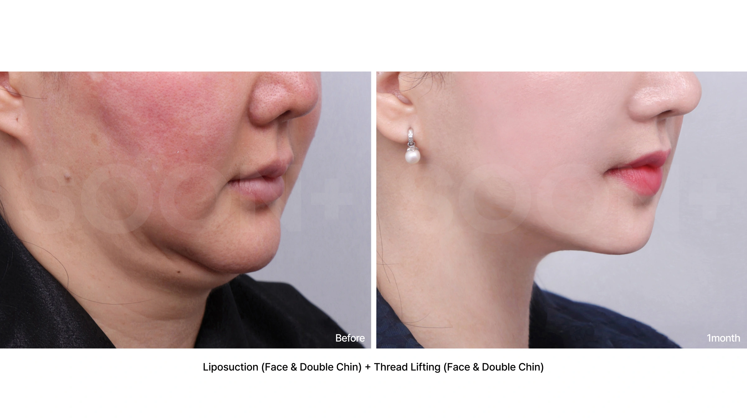 Facial liposuction with thread lifting at Soonplus Plastic Surgery. Soonplus Plastic Surgery, Seoul: facial liposuction with thread lifting, angled lower-face views, with before on the left and after on the right. The source labels the follow-up as 1 month.