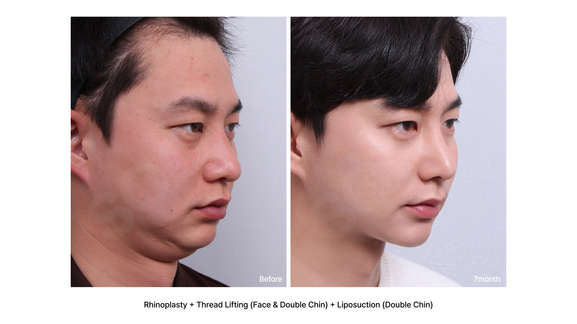 Rhinoplasty with thread lifting and double-chin liposuction at Soonplus Plastic Surgery. Soonplus Plastic Surgery, Seoul: rhinoplasty with thread lifting and double-chin liposuction, angled facial views, with before on the left and after on the right. The source labels the follow-up as 7 months.