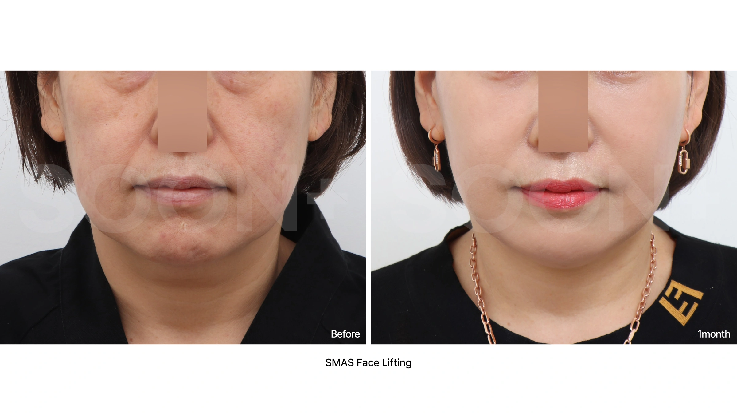 SMAS facelift — lower-face comparison 01 at Soonplus Plastic Surgery. Soonplus Plastic Surgery, Seoul: smas facelift — lower-face comparison 01, lower-face views, with before on the left and after on the right. The source labels the follow-up as 1 month.