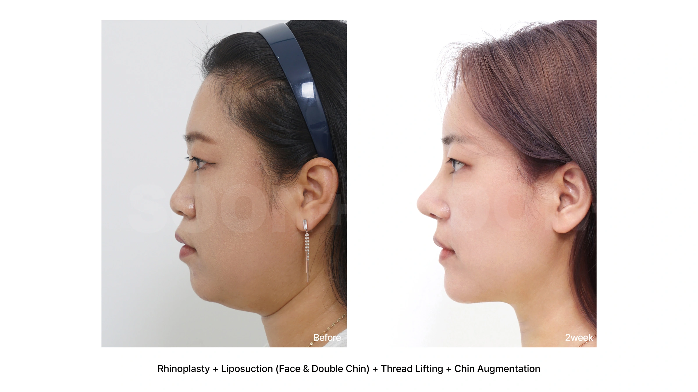 Rhinoplasty with chin augmentation and facial contouring at Soonplus Plastic Surgery. Soonplus Plastic Surgery, Seoul: rhinoplasty with chin augmentation and facial contouring, profile views, with before on the left and after on the right. The source labels the follow-up as 2 weeks.