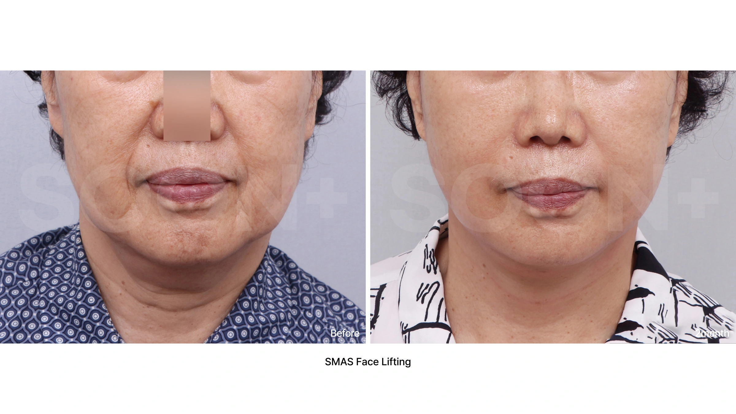 SMAS facelift — lower-face comparison 02 at Soonplus Plastic Surgery. Soonplus Plastic Surgery, Seoul: smas facelift — lower-face comparison 02, lower-face views, with before on the left and after on the right. The source labels the follow-up as 2 months.