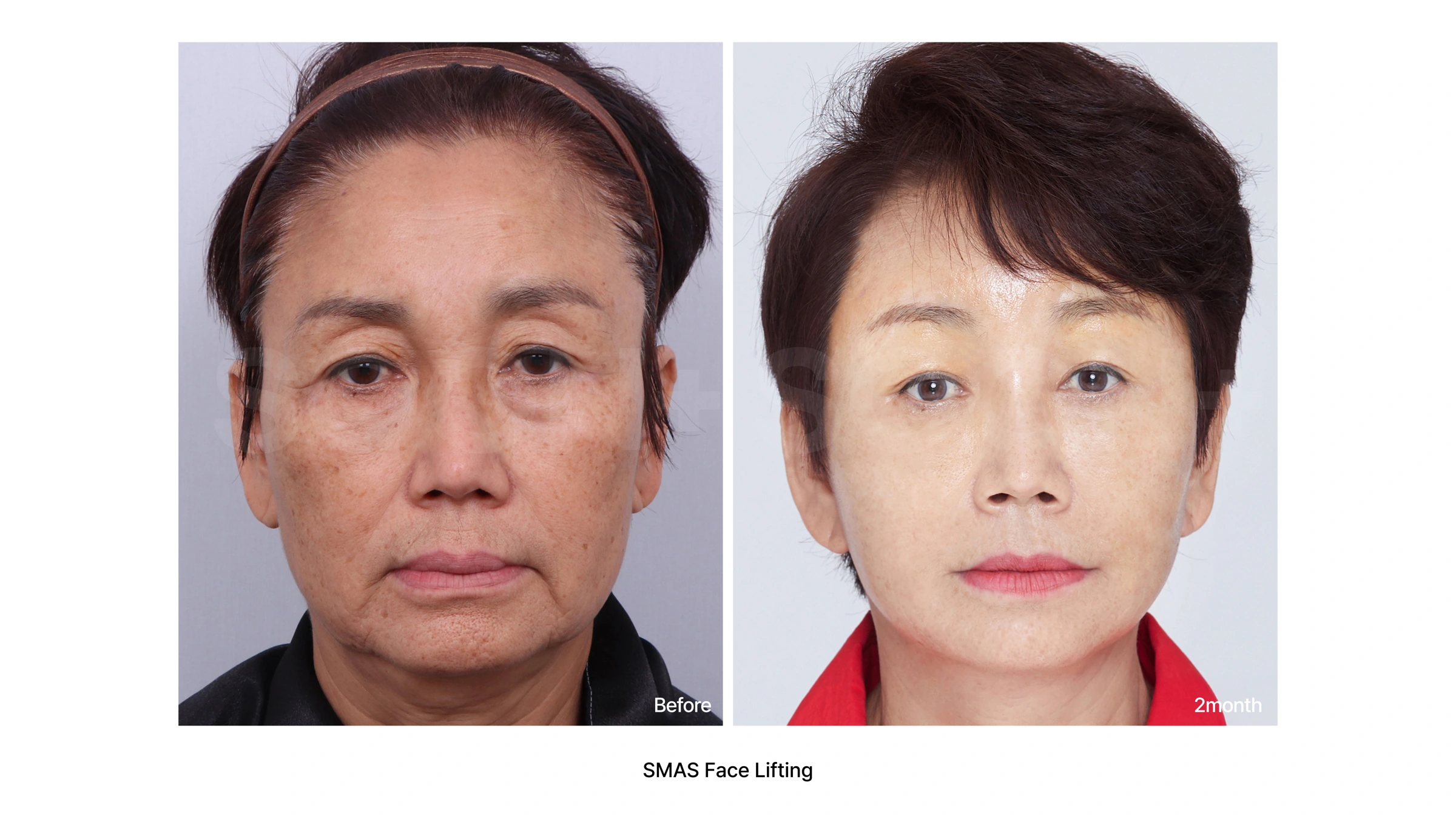 SMAS facelift — front comparison 01 at Soonplus Plastic Surgery. Soonplus Plastic Surgery, Seoul: smas facelift — front comparison 01, front facial views, with before on the left and after on the right. The source labels the follow-up as 2 months.