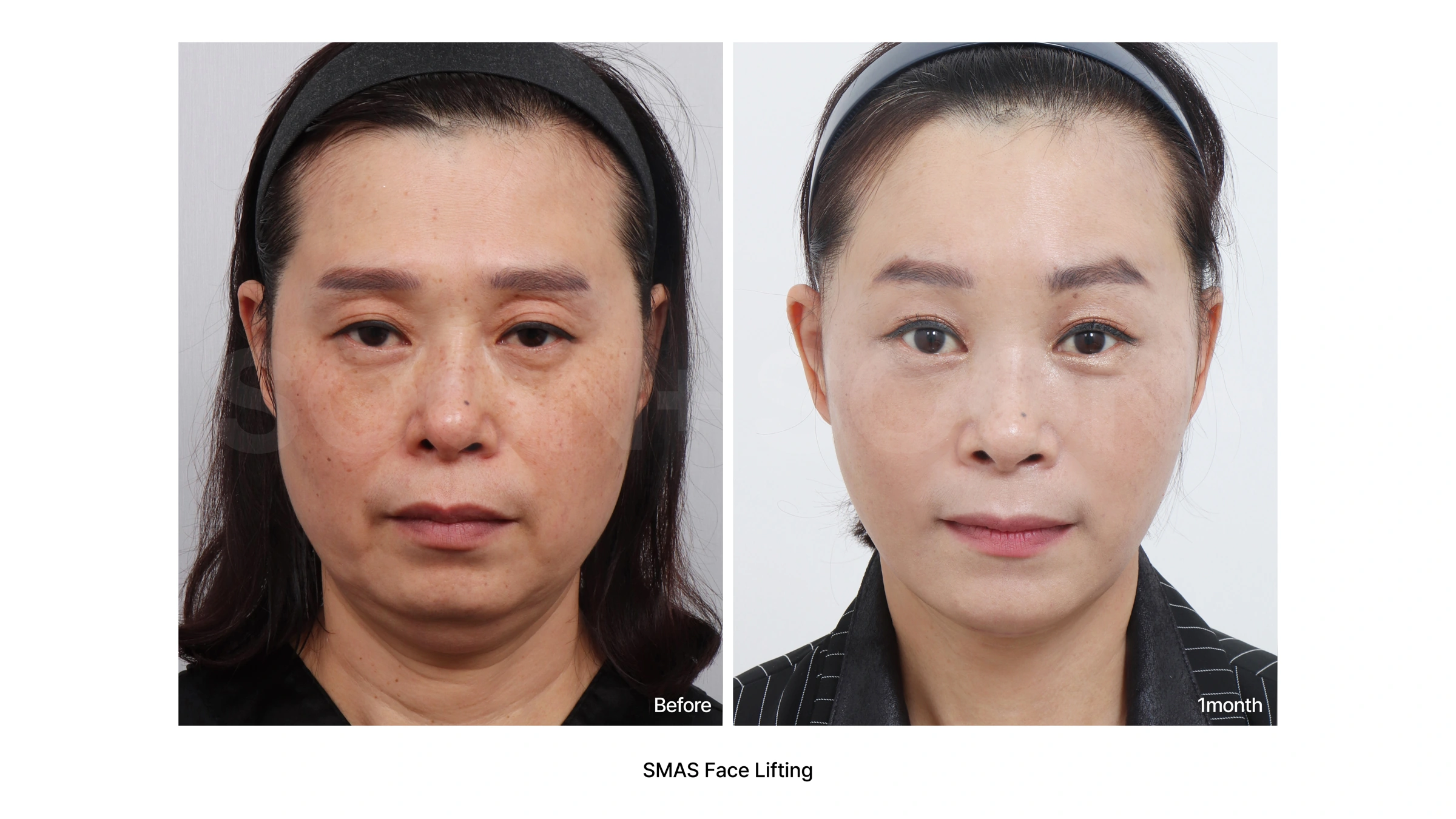 SMAS facelift — front comparison 02 at Soonplus Plastic Surgery. Soonplus Plastic Surgery, Seoul: smas facelift — front comparison 02, front facial views, with before on the left and after on the right. The source labels the follow-up as 1 month.
