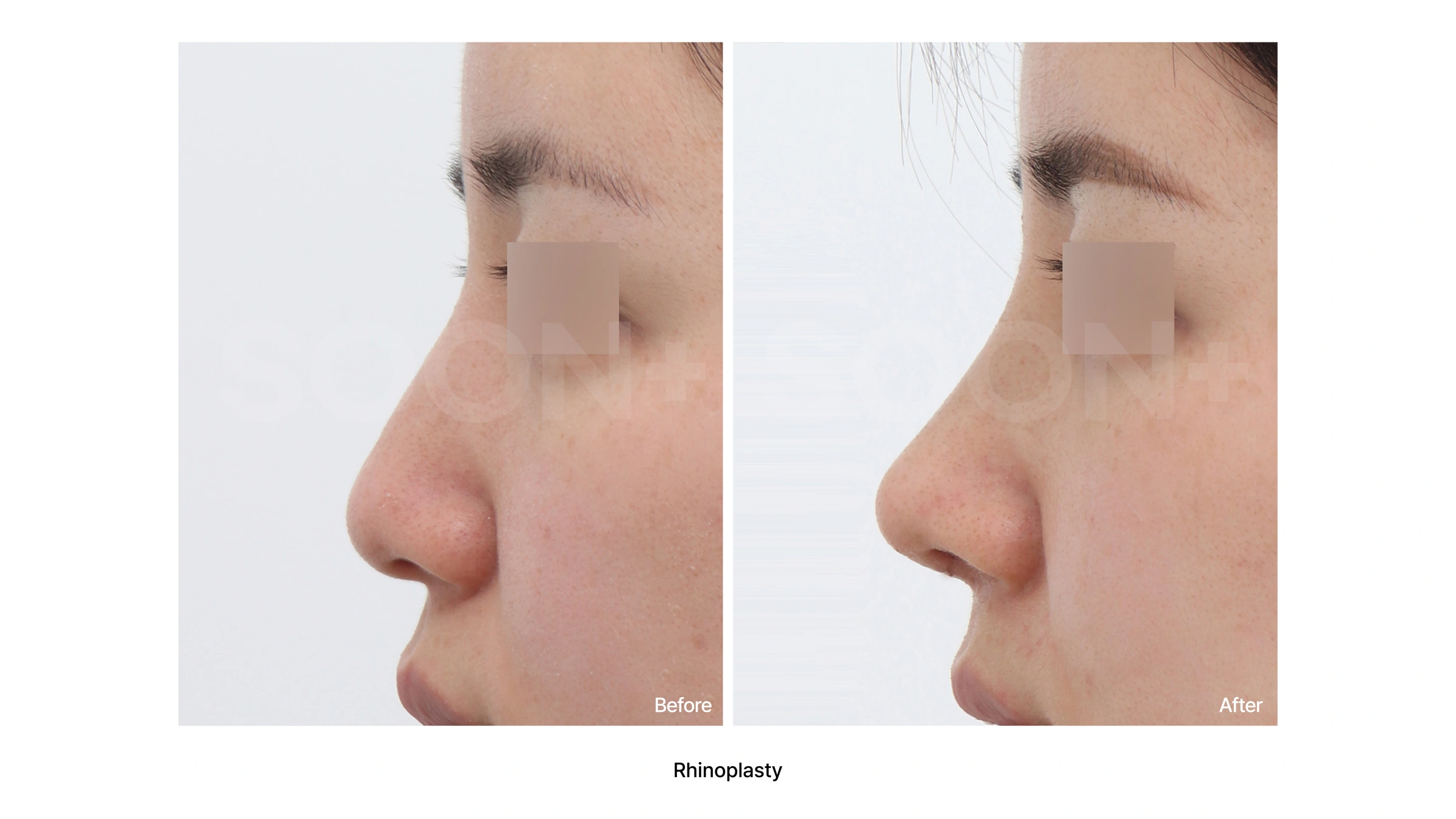 Rhinoplasty — profile comparison 01 at Soonplus Plastic Surgery. Soonplus Plastic Surgery, Seoul: rhinoplasty — profile comparison 01, profile views, with before on the left and after on the right.