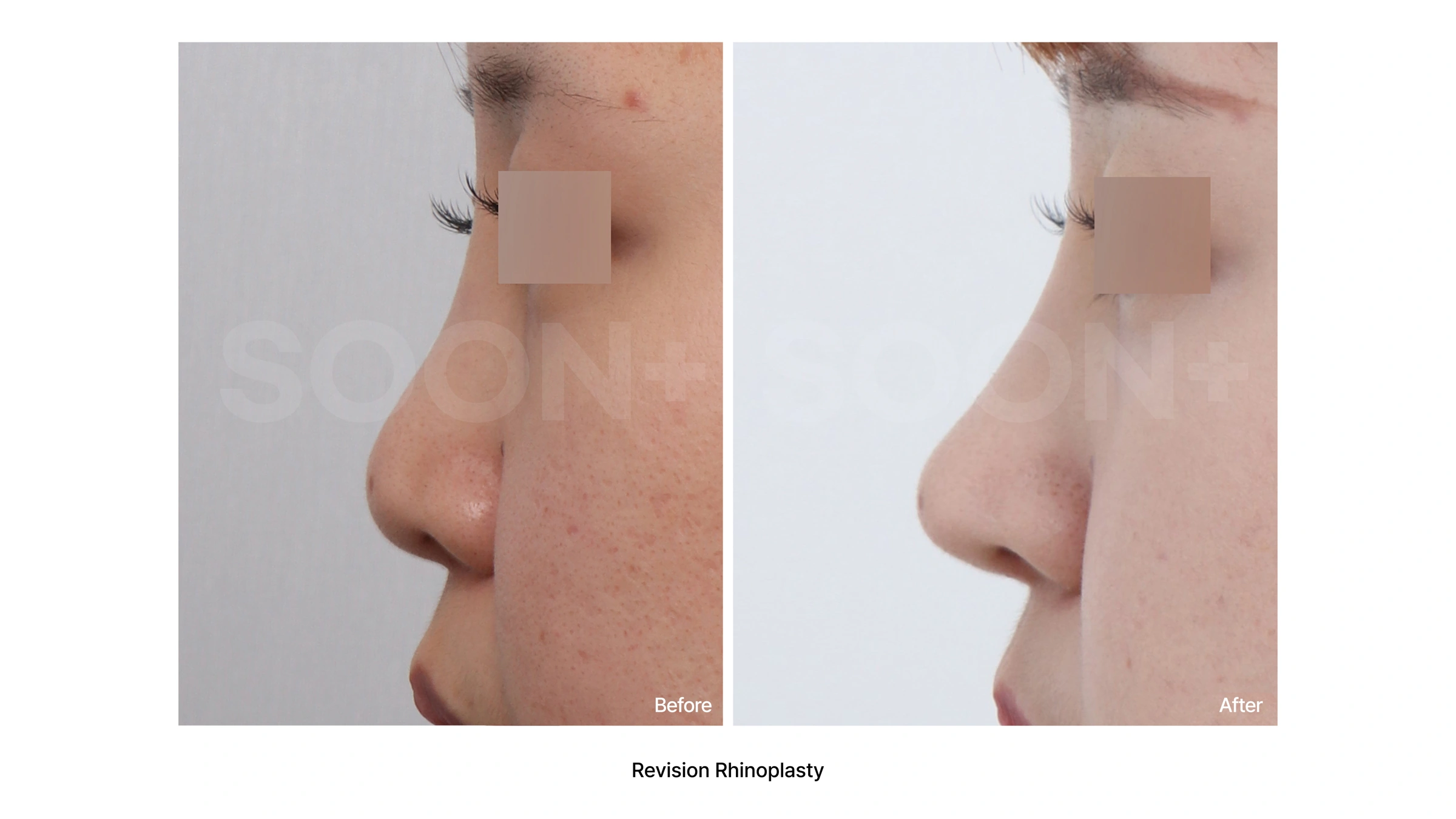 Revision rhinoplasty — profile comparison 01 at Soonplus Plastic Surgery. Soonplus Plastic Surgery, Seoul: revision rhinoplasty — profile comparison 01, profile views, with before on the left and after on the right.