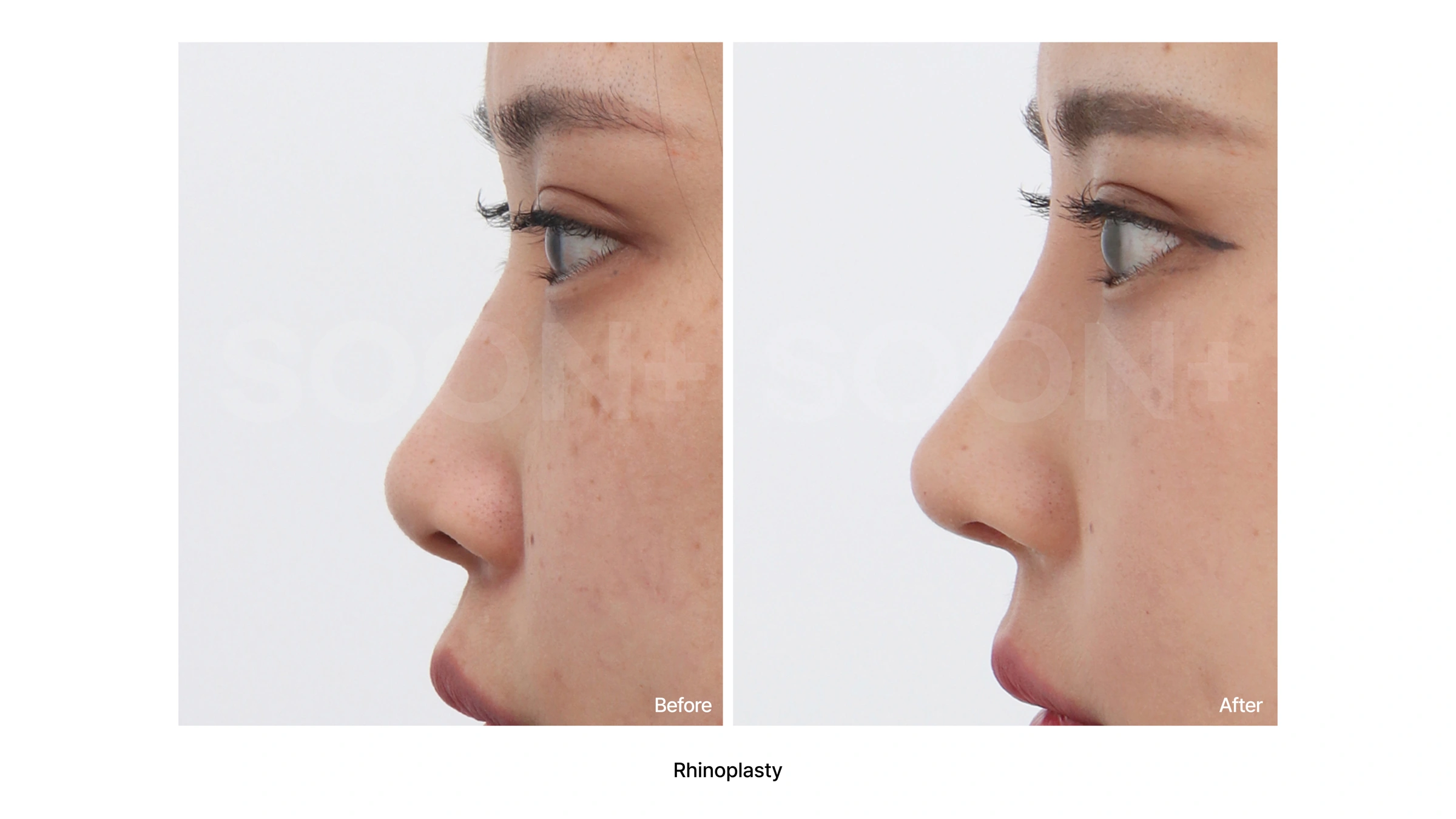 Rhinoplasty — profile comparison 02 at Soonplus Plastic Surgery. Soonplus Plastic Surgery, Seoul: rhinoplasty — profile comparison 02, profile views, with before on the left and after on the right.
