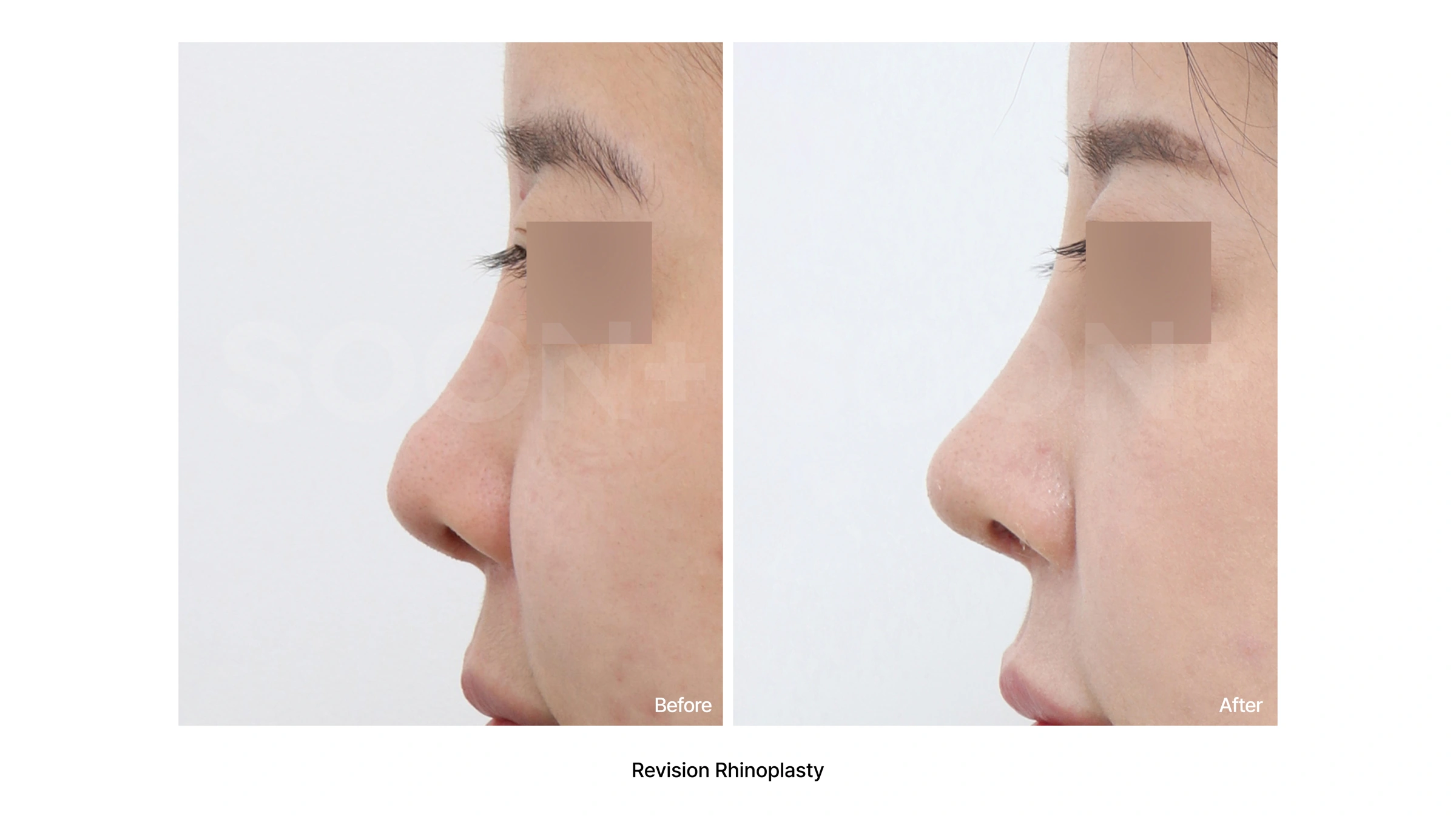 Revision rhinoplasty — profile comparison 02 at Soonplus Plastic Surgery. Soonplus Plastic Surgery, Seoul: revision rhinoplasty — profile comparison 02, profile views, with before on the left and after on the right.