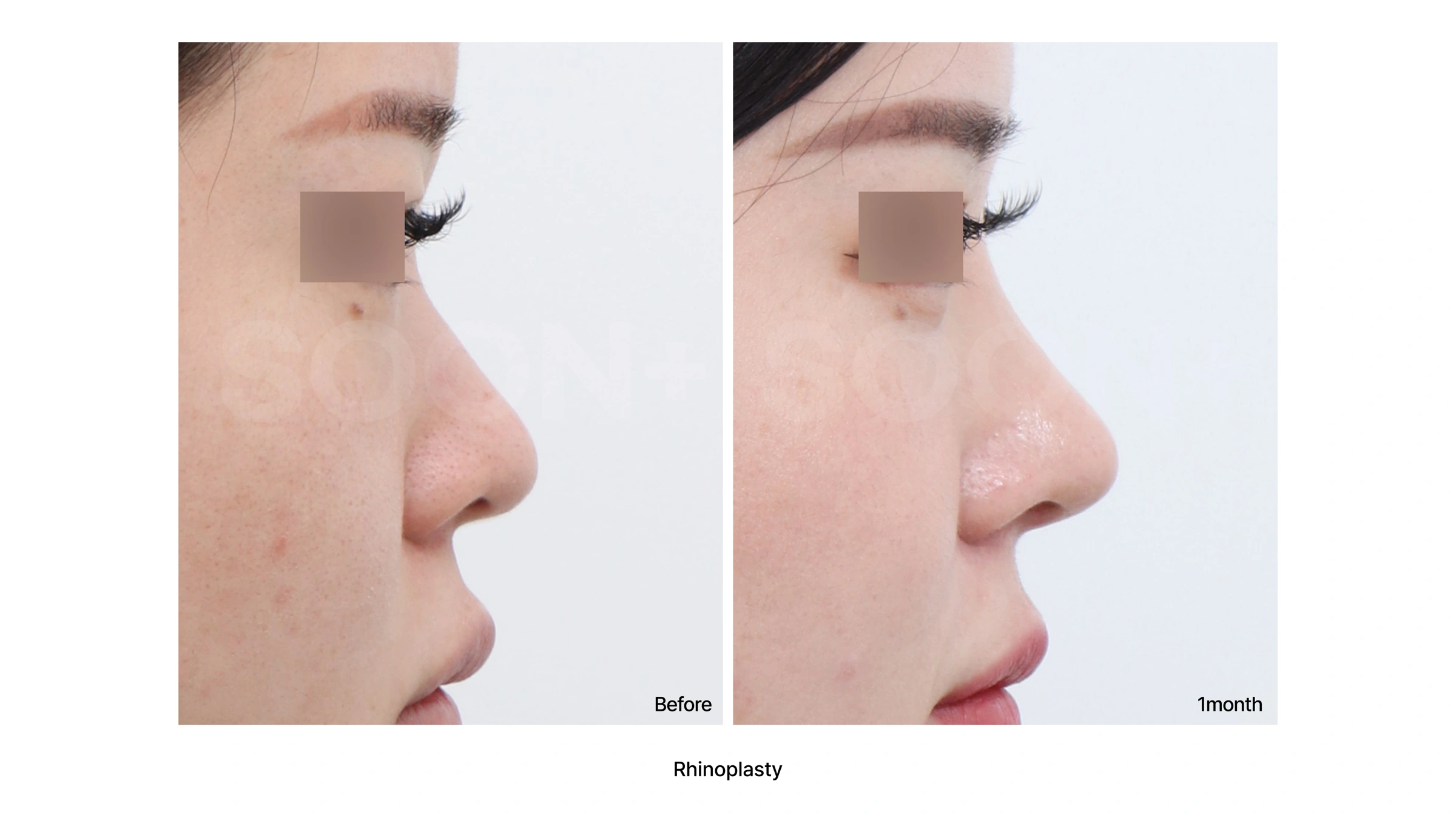 Rhinoplasty at one month at Soonplus Plastic Surgery. Soonplus Plastic Surgery, Seoul: rhinoplasty at one month, profile views, with before on the left and after on the right. The source labels the follow-up as 1 month.