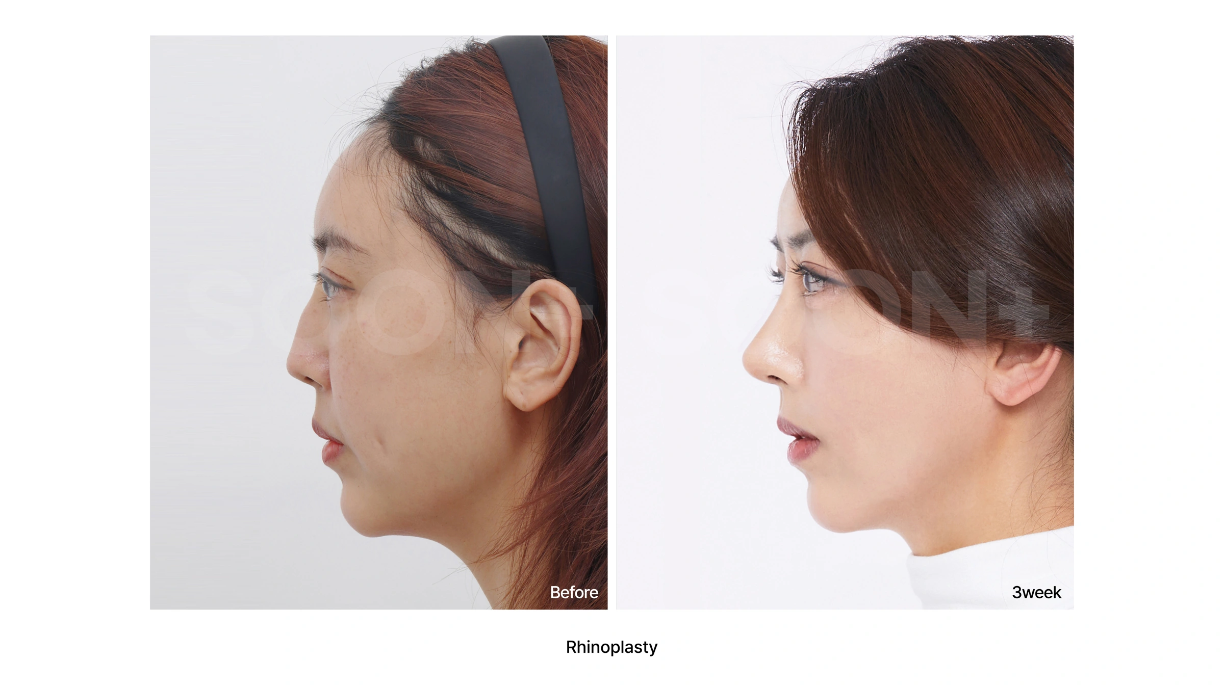 Rhinoplasty at three weeks at Soonplus Plastic Surgery. Soonplus Plastic Surgery, Seoul: rhinoplasty at three weeks, profile views, with before on the left and after on the right. The source labels the follow-up as 3 weeks.