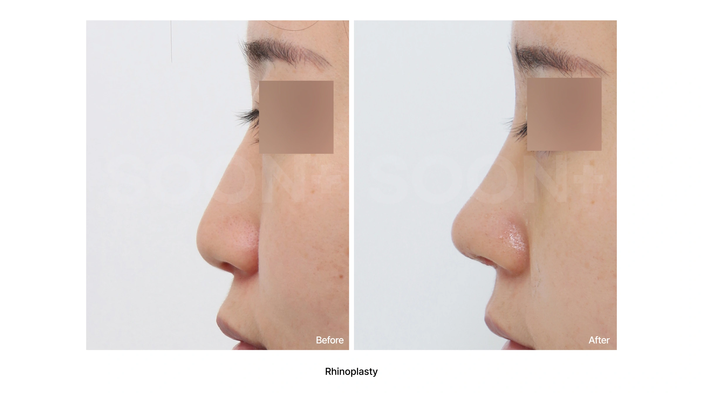 Rhinoplasty — profile comparison 03 at Soonplus Plastic Surgery. Soonplus Plastic Surgery, Seoul: rhinoplasty — profile comparison 03, profile views, with before on the left and after on the right.