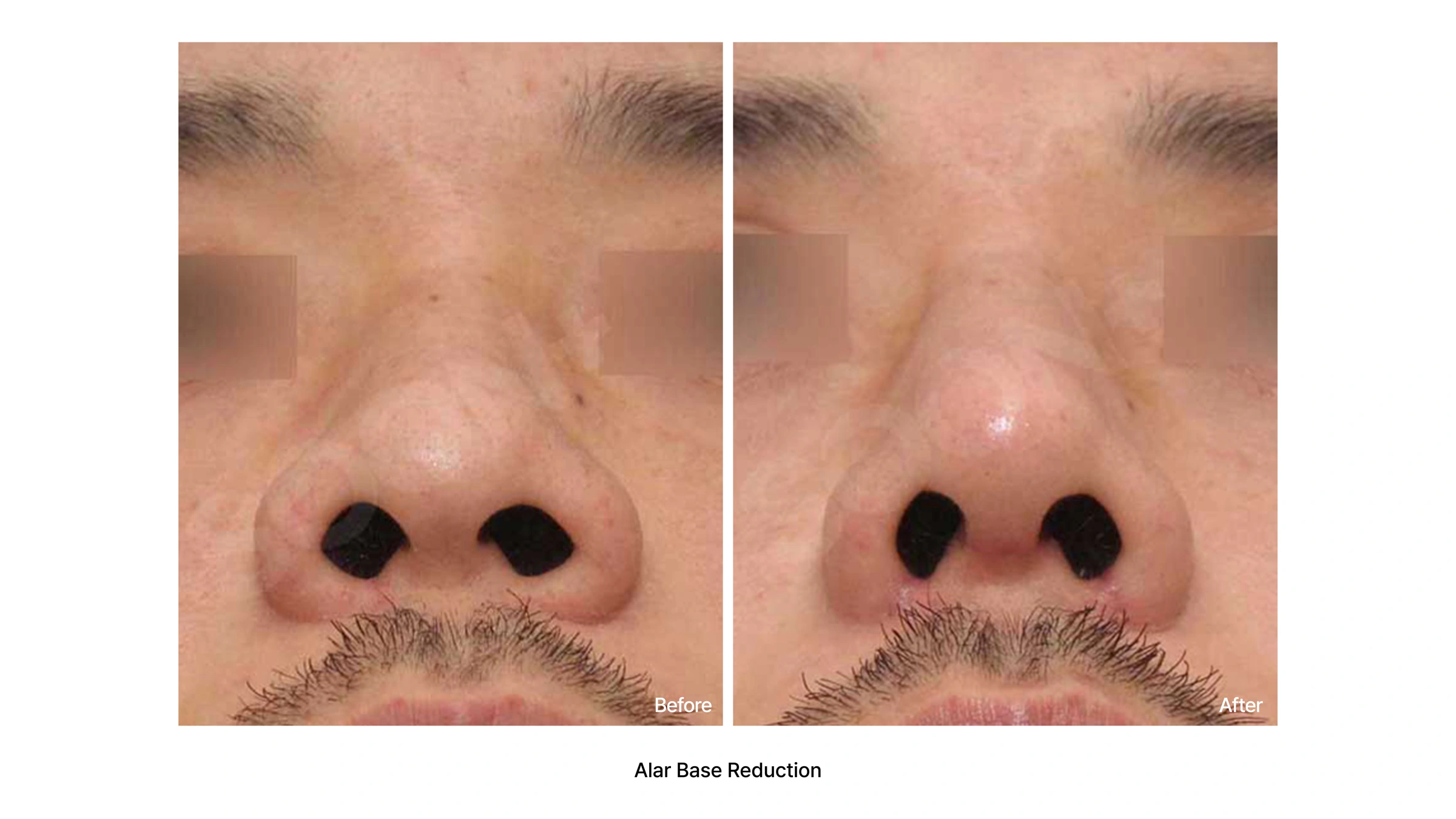 Alar base reduction — comparison 02 at Soonplus Plastic Surgery. Soonplus Plastic Surgery, Seoul: alar base reduction — comparison 02, upward-facing nasal-base views, with before on the left and after on the right.