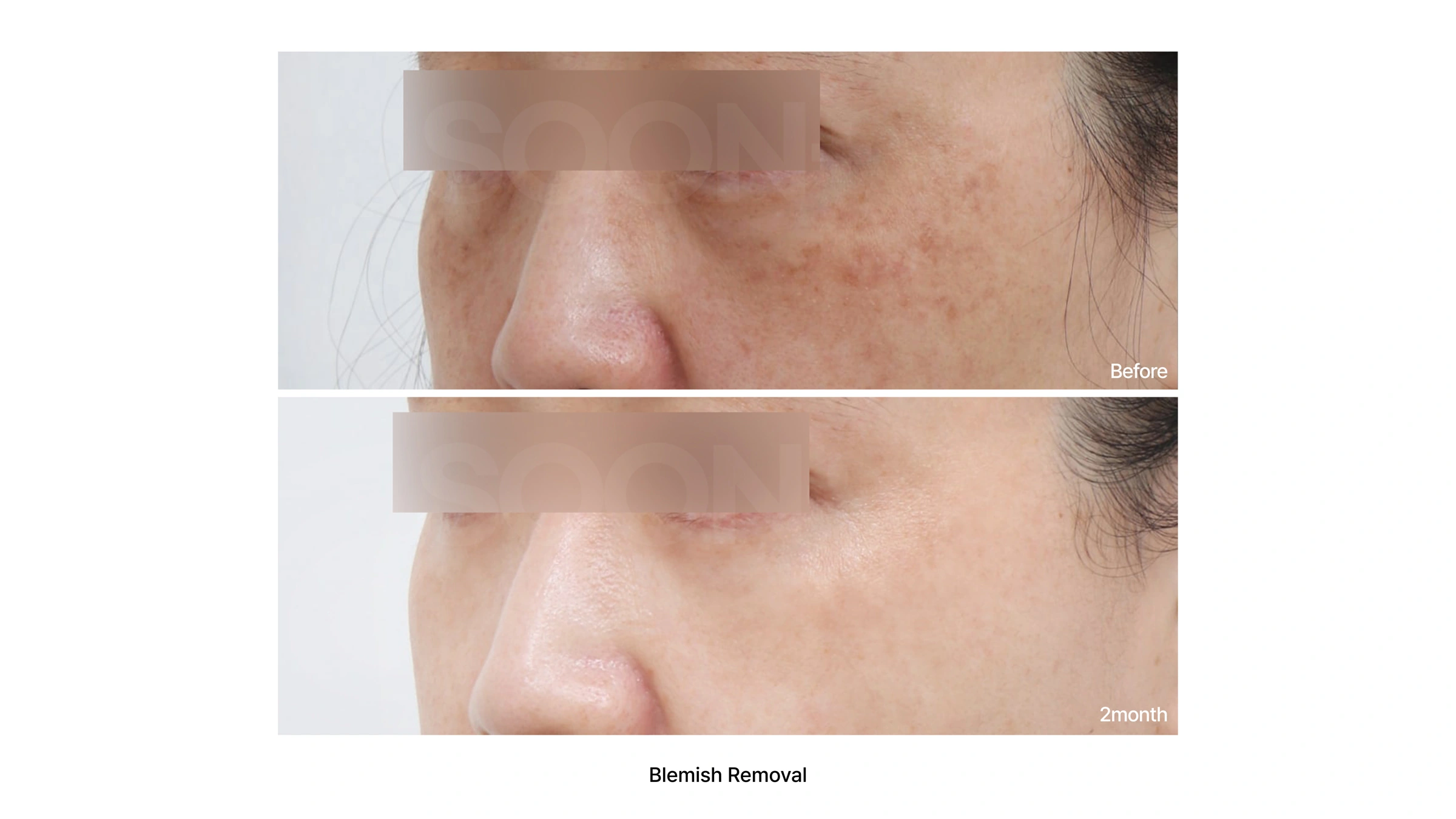 Cheek pigmentation treatment at Soonplus Plastic Surgery. Soonplus Plastic Surgery, Seoul: cheek pigmentation treatment, close-up cheek views, with before above and after below. The source labels the follow-up as 2 months.
