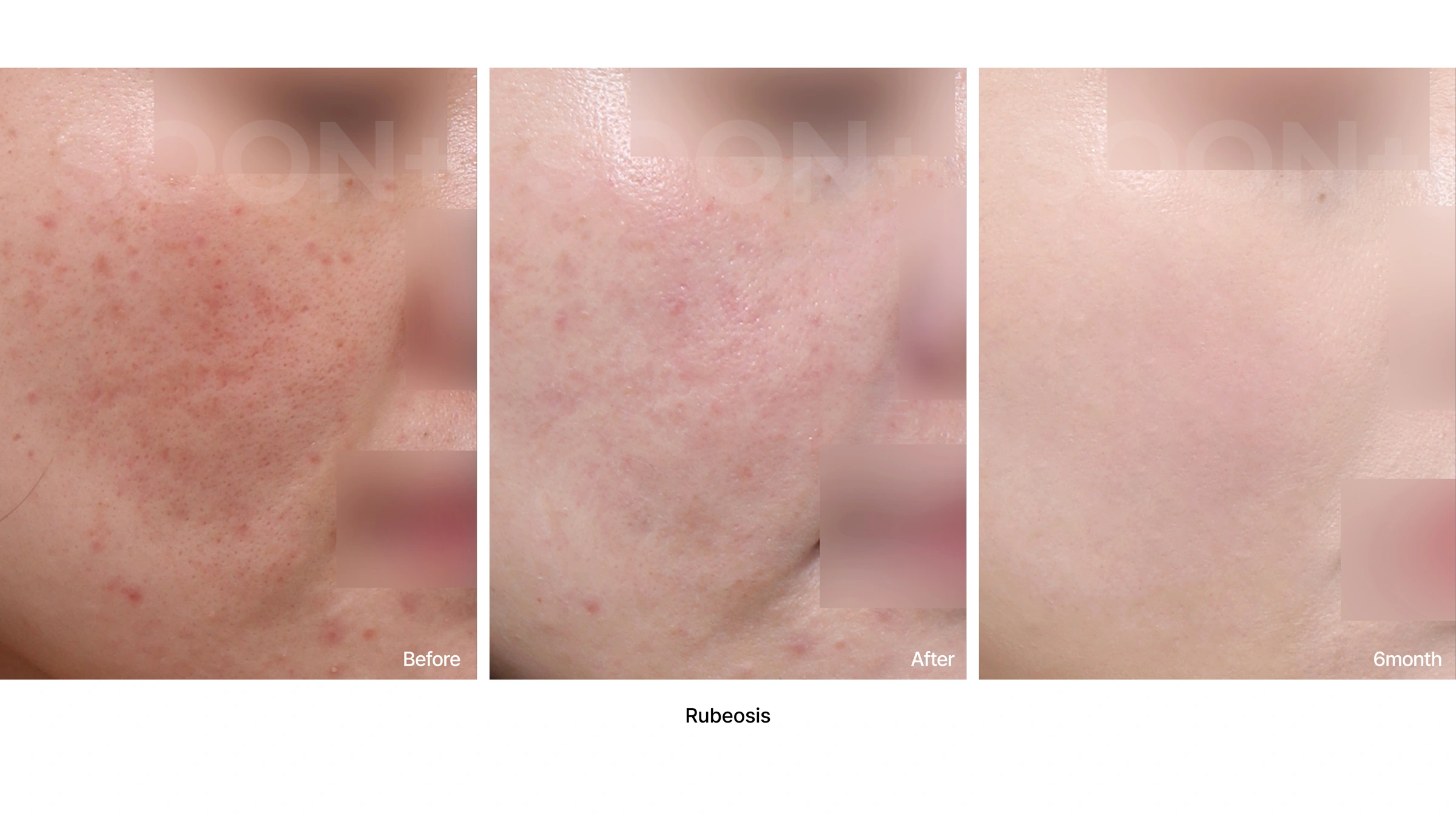 Facial redness treatment at Soonplus Plastic Surgery. Soonplus Plastic Surgery, Seoul: facial redness treatment, close-up cheek views, with before, after and six-month panels from left to right.