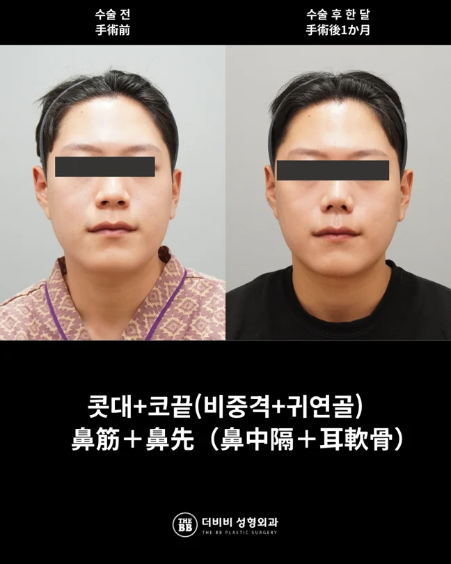 Nasal bridge and tip surgery at one month at THE BB Plastic Surgery. Before on the left; after on the right. 1 month follow-up.