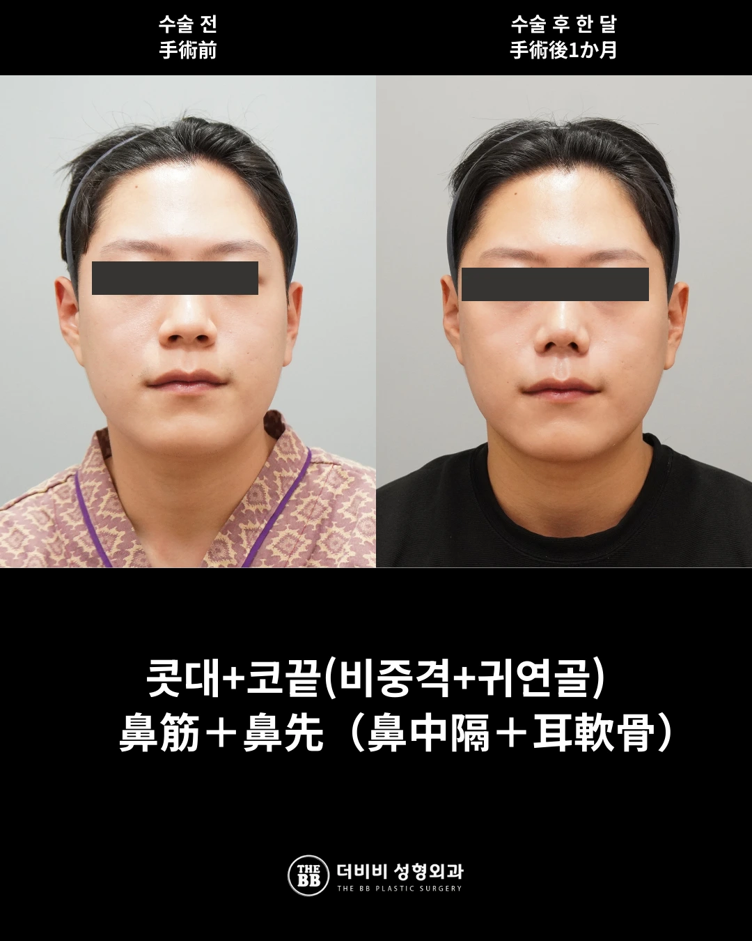Nasal bridge and tip surgery at one month at THE BB Plastic Surgery. Before on the left; after on the right. 1 month follow-up.