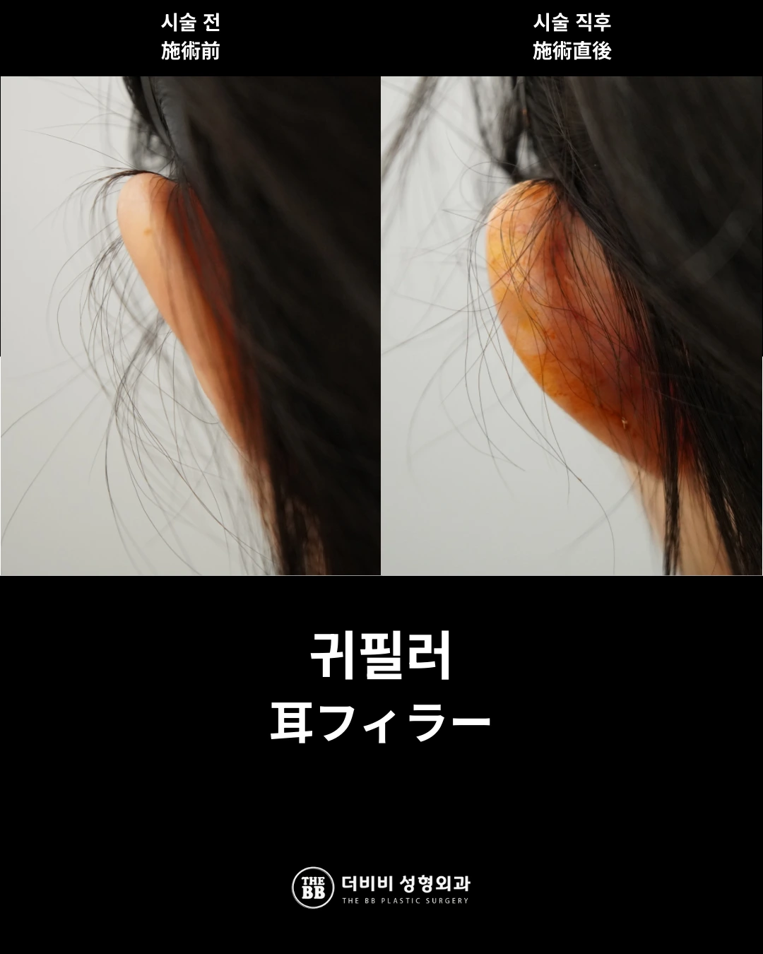 Ear filler: immediately after treatment at THE BB Plastic Surgery. Before on the left; after on the right. Immediately after treatment.