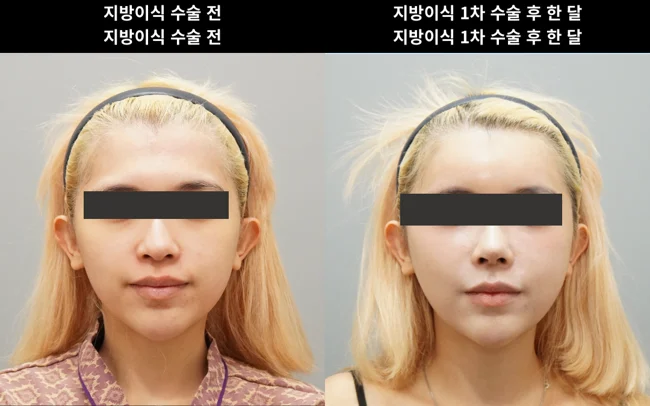Facial fat grafting: one month after the first session at THE BB Plastic Surgery. Before on the left; after on the right. 1 month follow-up.