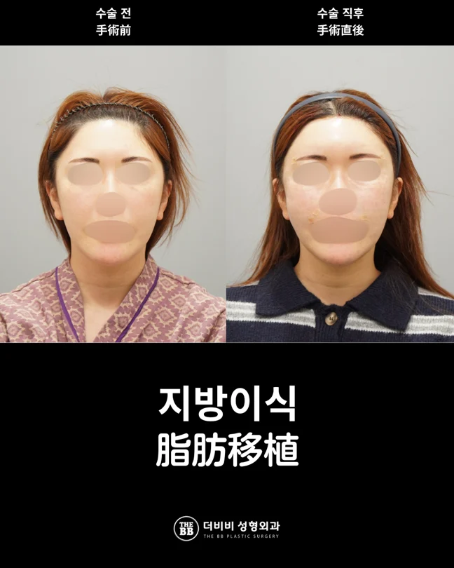 Facial fat grafting: immediately after surgery at THE BB Plastic Surgery. Before on the left; after on the right. Immediately after surgery.