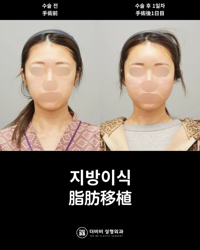 Facial fat grafting: the first postoperative day at THE BB Plastic Surgery. Before on the left; after on the right. 1 day follow-up.
