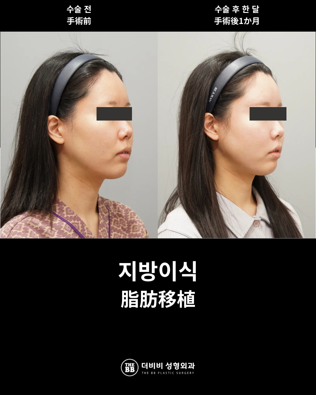 Facial fat grafting at one month: angled view at THE BB Plastic Surgery. Before on the left; after on the right. 1 month follow-up.