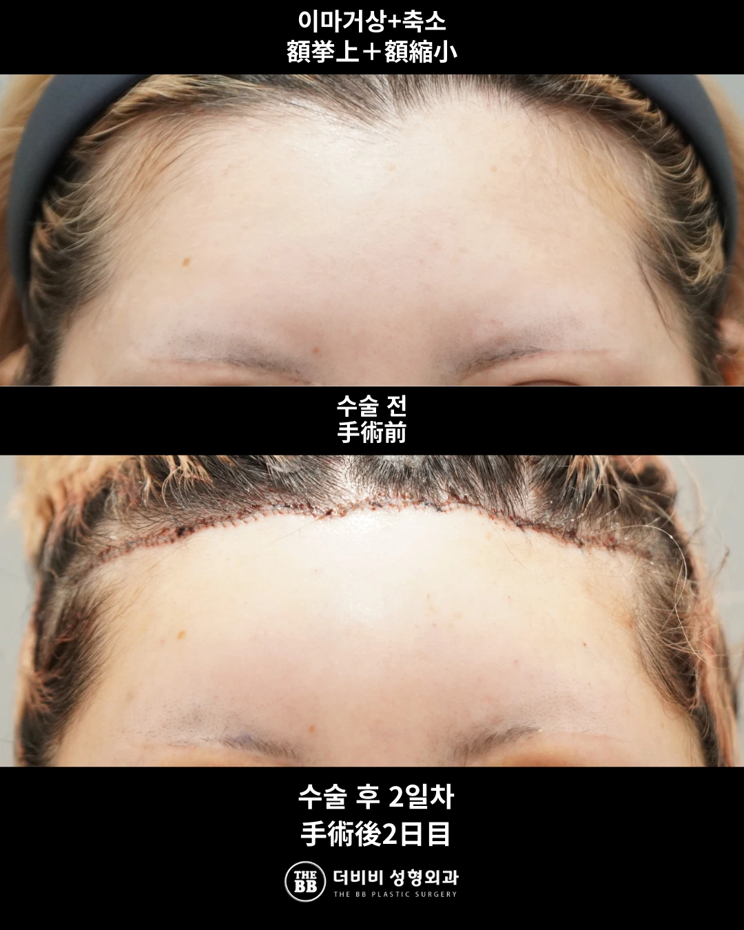 Forehead lift and reduction at two days at THE BB Plastic Surgery. Before above; after below. 2 days follow-up.