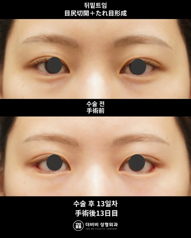 Lateral and lower canthoplasty at thirteen days at THE BB Plastic Surgery. Before above; after below. 13 days follow-up.