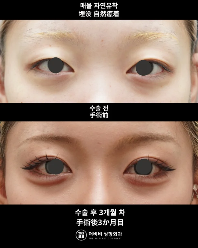 Non-incisional double eyelids at three months at THE BB Plastic Surgery. Before above; after below. 3 months follow-up.