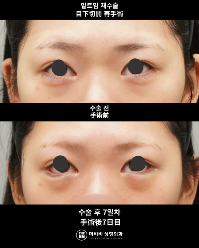 Revision lower canthoplasty at seven days at THE BB Plastic Surgery. Before above; after below. 7 days follow-up.