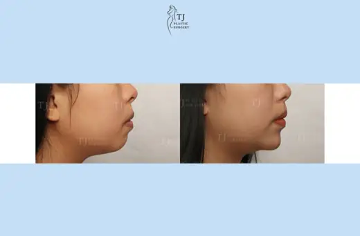 Chin fillers — front view before and after at TJ Plastic Surgery Clinic