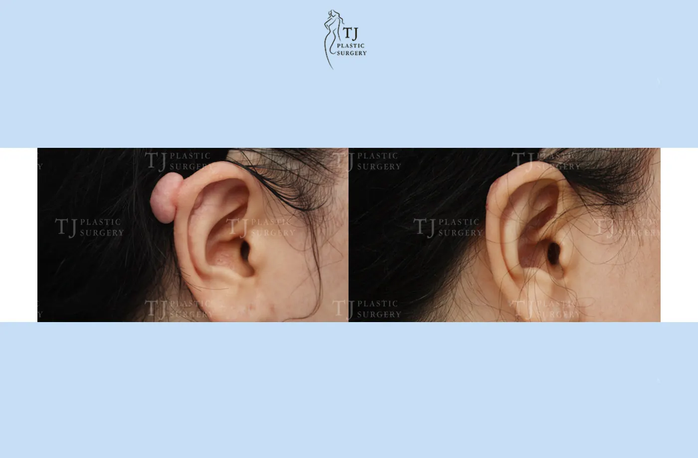 Ear keloid treatment at TJ Plastic Surgery Clinic — Close-up of the ear; before on the left · after 1 month