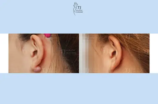 Ear keloid treatment — close-up of the ear at 2 months before and after at TJ Plastic Surgery Clinic