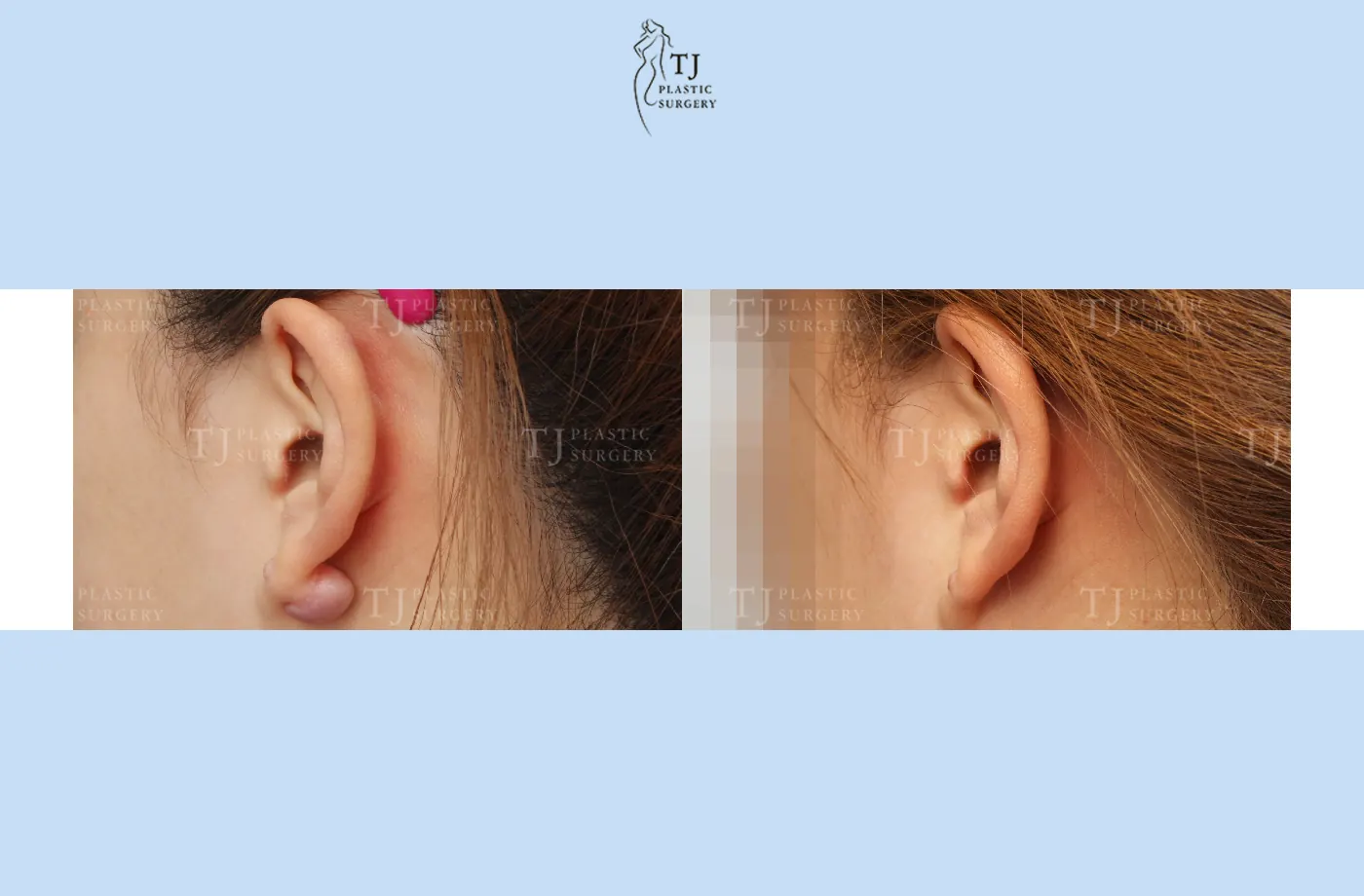 Ear keloid treatment at TJ Plastic Surgery Clinic — Close-up of the ear; before on the left · after 2 months