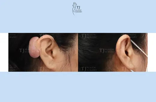 Ear keloid treatment — close-up of the ear at 3 months before and after at TJ Plastic Surgery Clinic