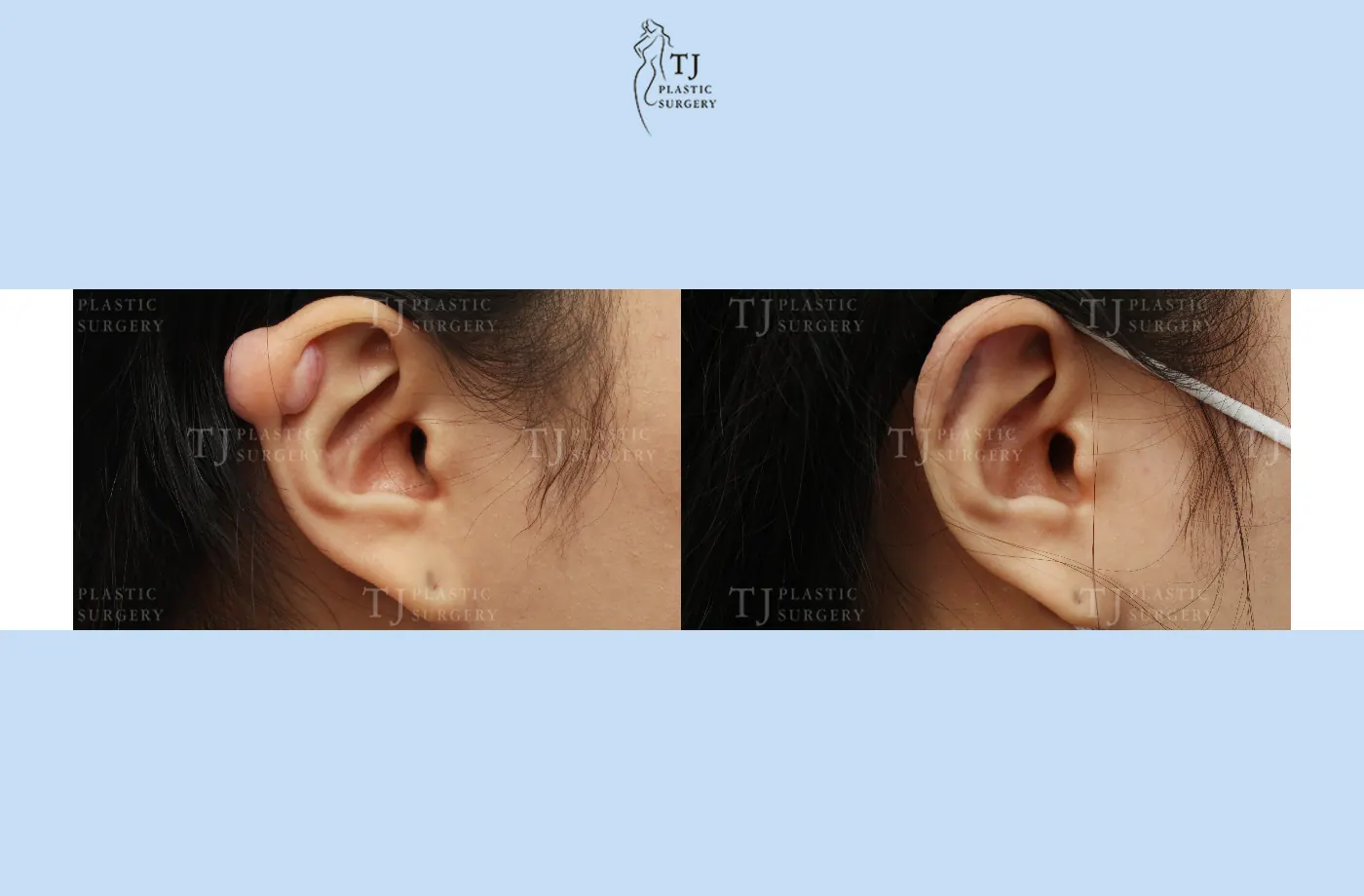 Ear keloid treatment at TJ Plastic Surgery Clinic — Close-up of the ear; before on the left · after 1 month