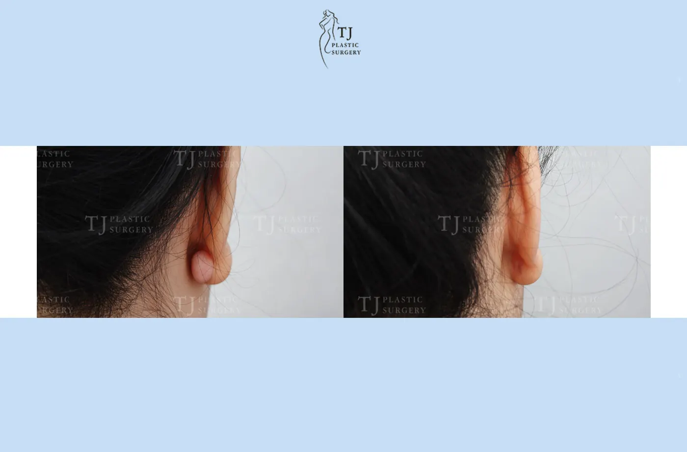 Ear keloid treatment at TJ Plastic Surgery Clinic — Close-up of the ear; before on the left · after 3 months