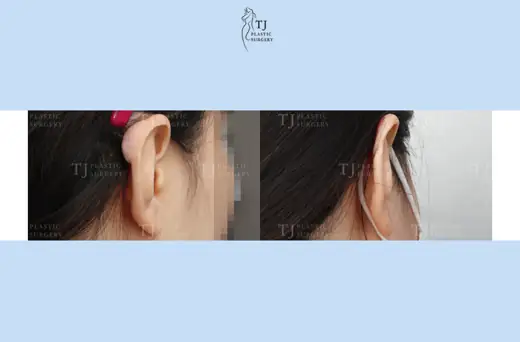 Ear keloid treatment — close-up of the ear at 1 month before and after at TJ Plastic Surgery Clinic