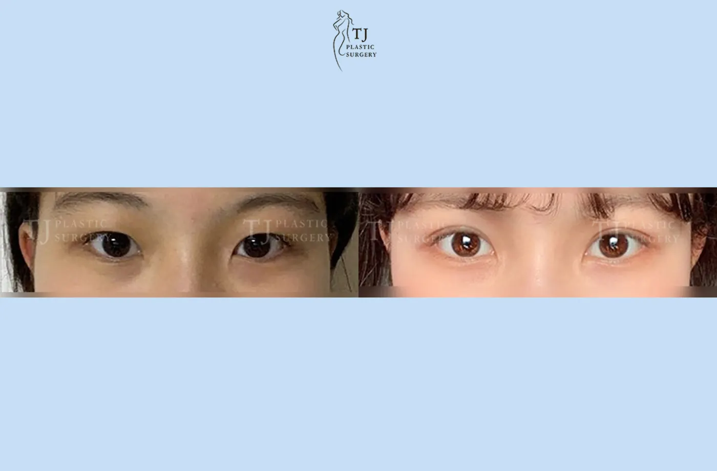 Eyelid surgery at TJ Plastic Surgery Clinic — Front view; before on the left · after on the right
