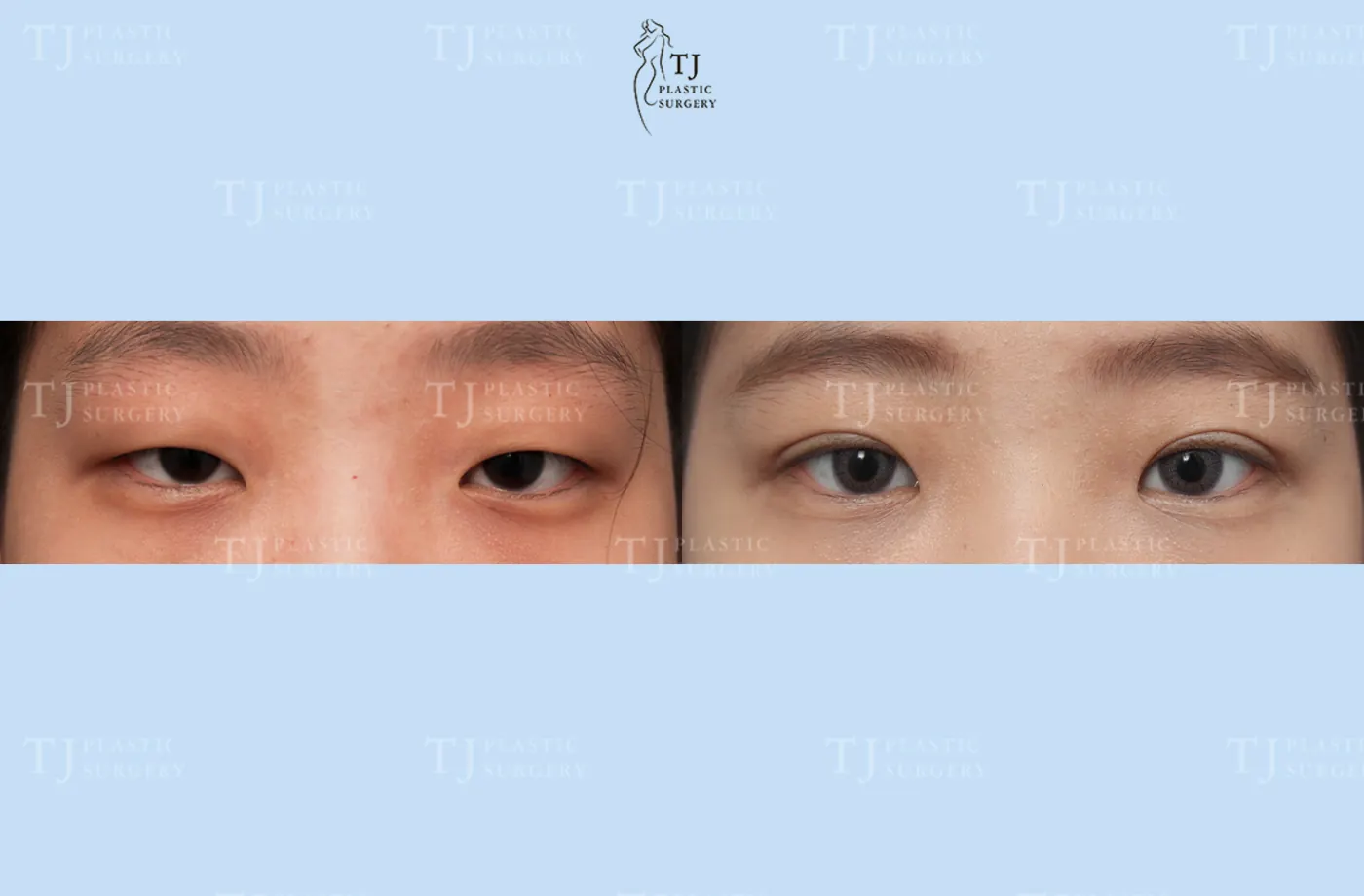Eyelid surgery at TJ Plastic Surgery Clinic — Front view; before on the left · after on the right