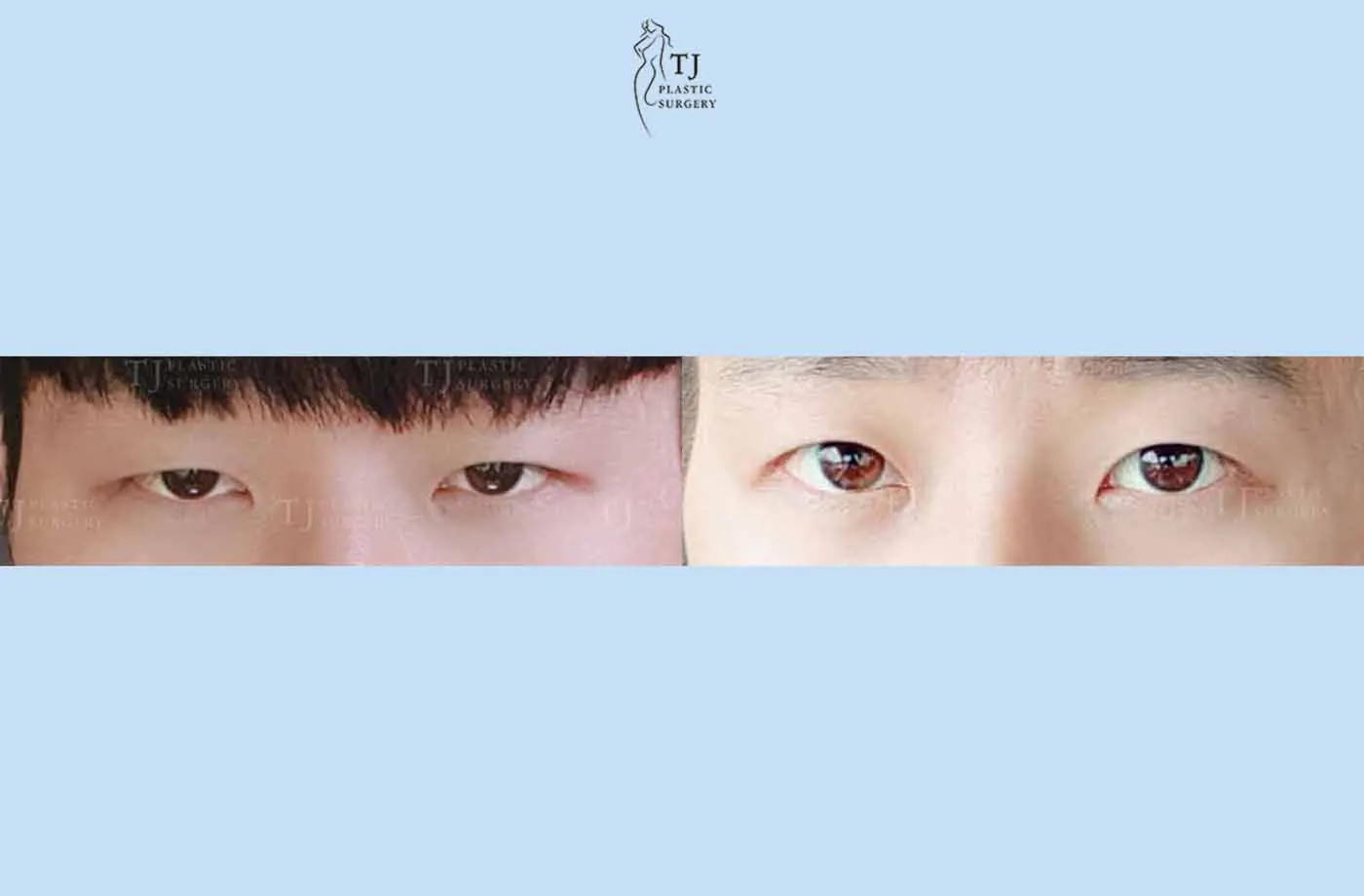 Eyelid surgery at TJ Plastic Surgery Clinic — Front view; before on the left · after on the right