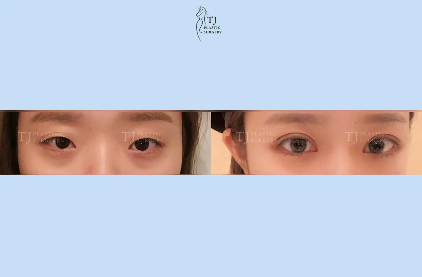 Eyelid surgery at TJ Plastic Surgery Clinic — Front view; before on the left · after on the right