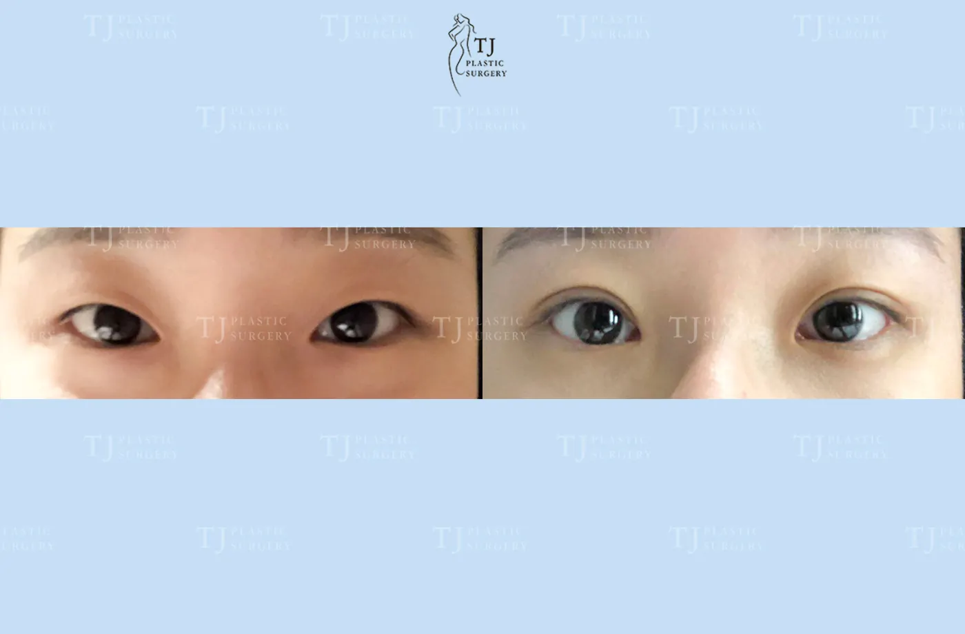 Eyelid surgery at TJ Plastic Surgery Clinic — Front view; before on the left · after on the right
