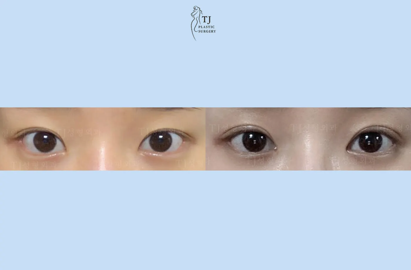 Eyelid surgery at TJ Plastic Surgery Clinic — Front view; before on the left · after on the right