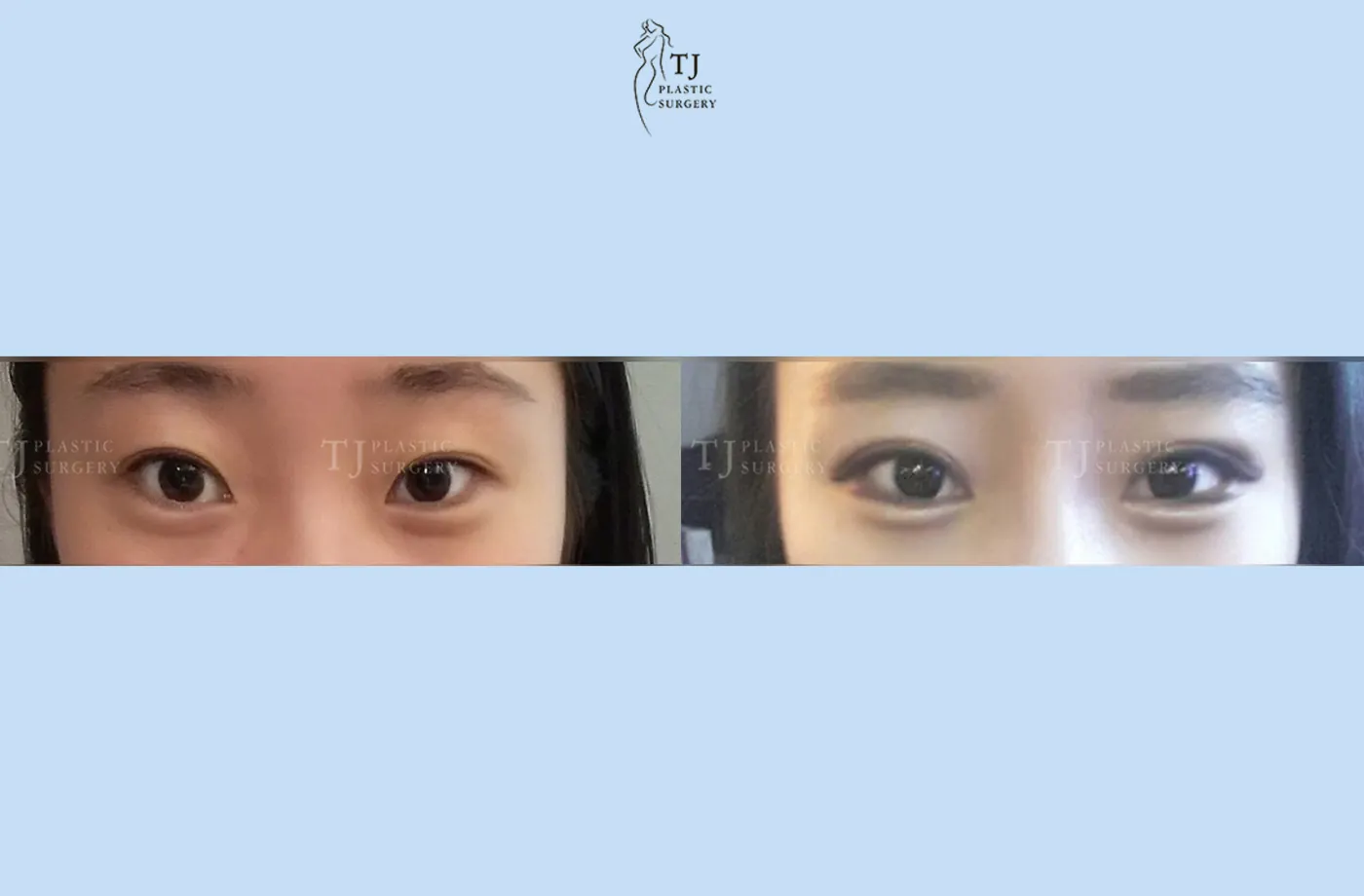 Eyelid surgery at TJ Plastic Surgery Clinic — Front view; before on the left · after on the right