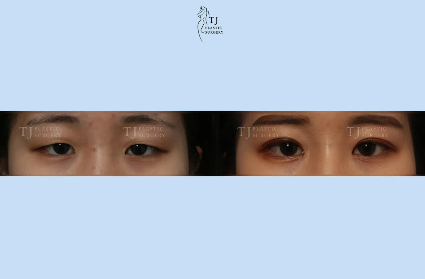 Eyelid surgery at TJ Plastic Surgery Clinic — Front view; before on the left · after on the right