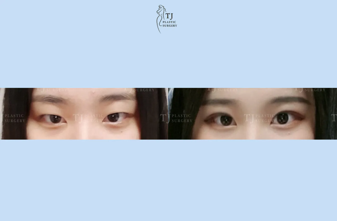 Eyelid surgery at TJ Plastic Surgery Clinic — Front view; before on the left · after on the right