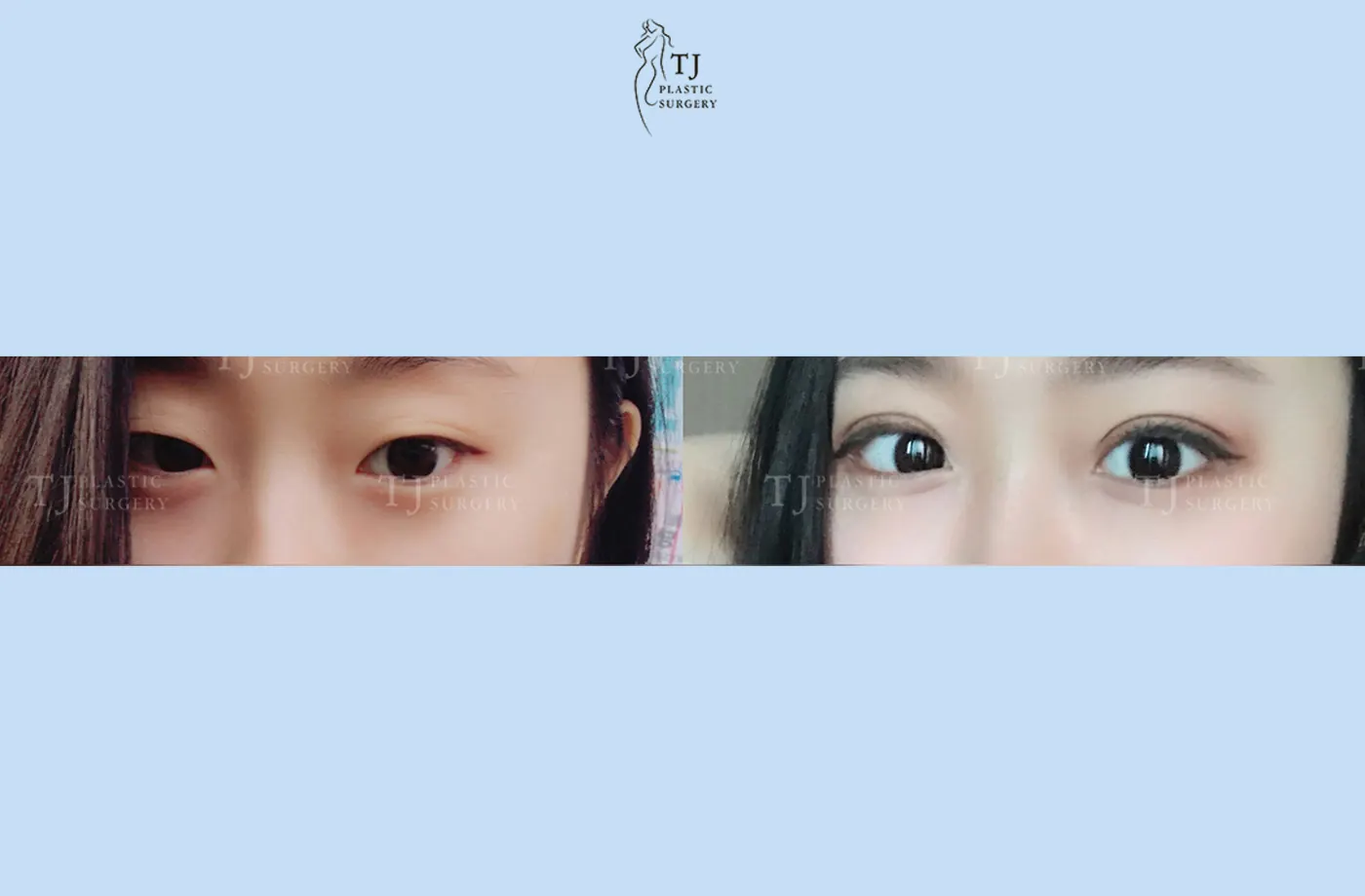 Eyelid surgery at TJ Plastic Surgery Clinic — Front view; before on the left · after on the right