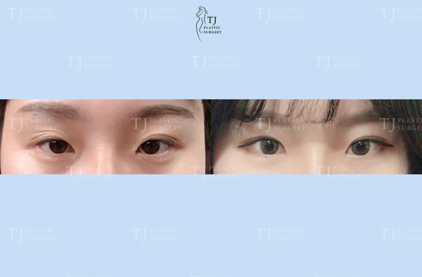Eyelid surgery at TJ Plastic Surgery Clinic — Front view; before on the left · after on the right