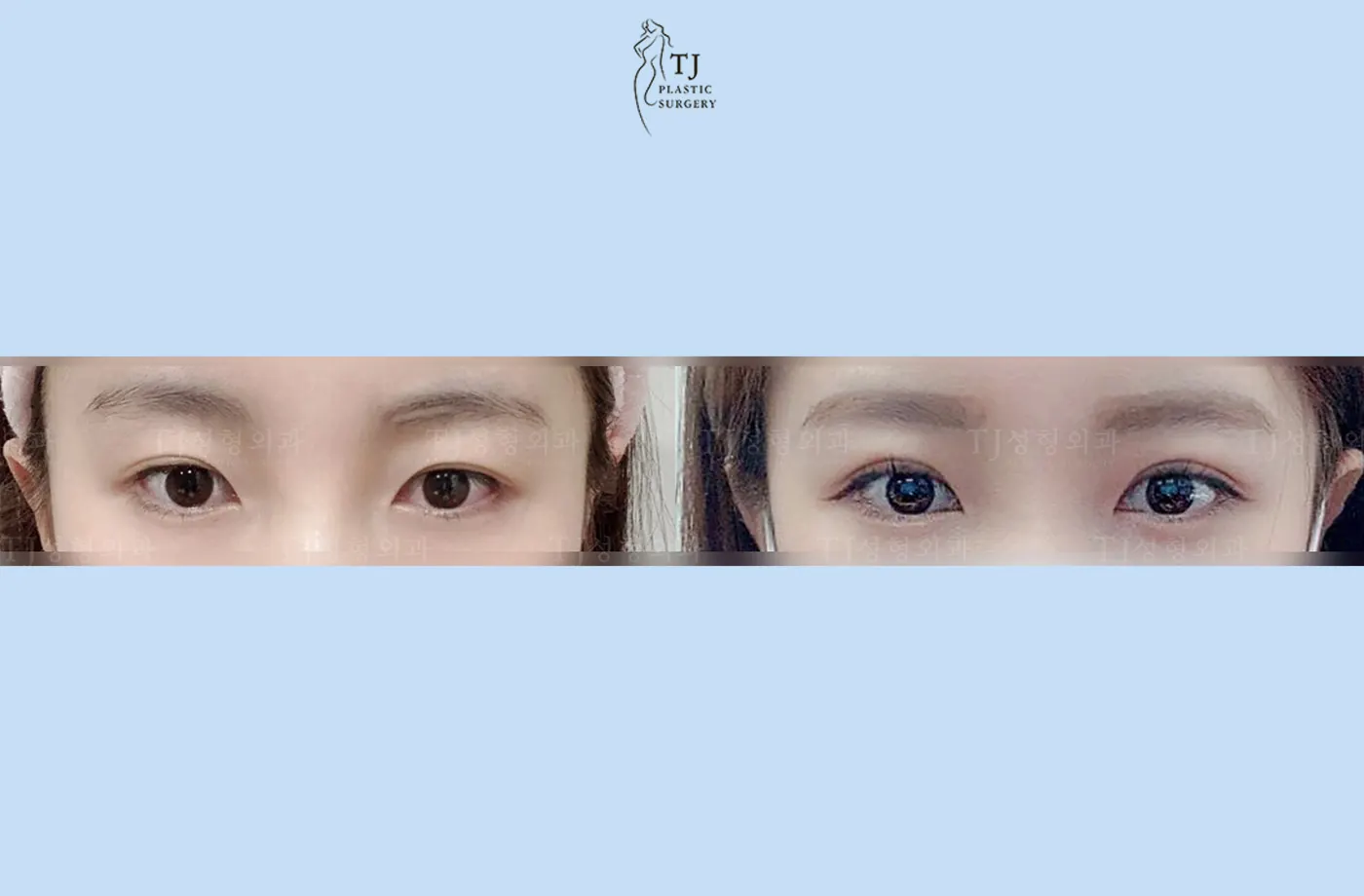 Eyelid surgery at TJ Plastic Surgery Clinic — Front view; before on the left · after on the right